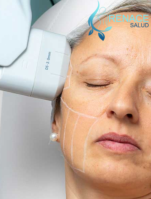 HIFU facial y corporal